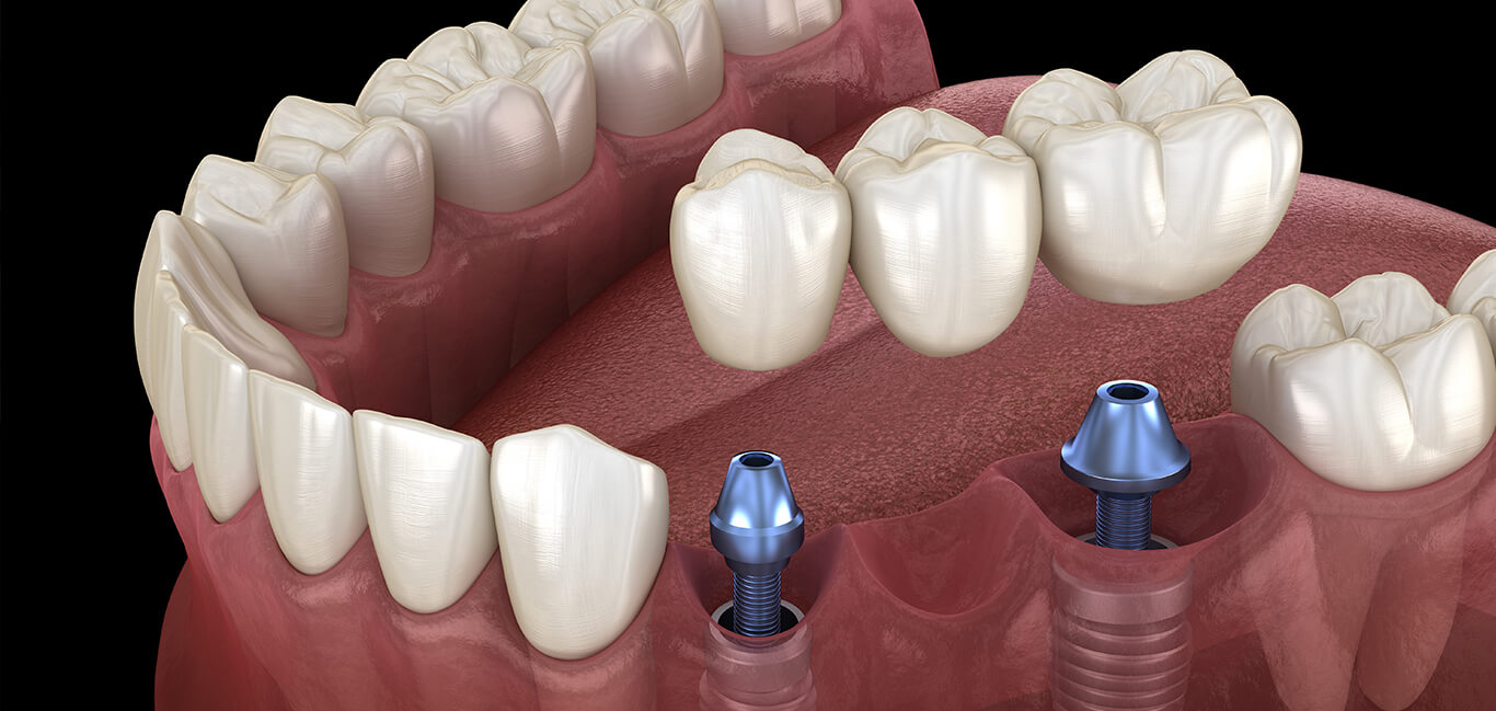 Quanto dura un impianto dentale?