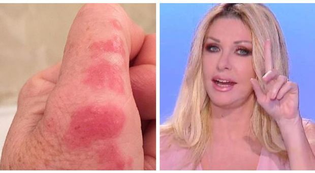 Paola Ferrari punta da una medusa! Dopo 5 giorni la situazione non cambia