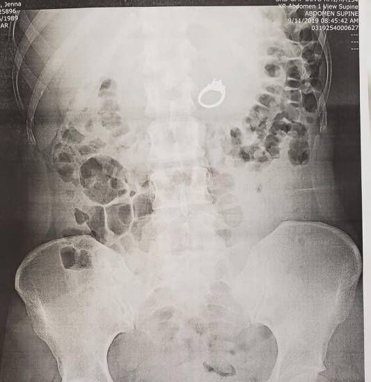 Jenna Evans sogna di ingoiare l'anello e finisce al pronto soccorso