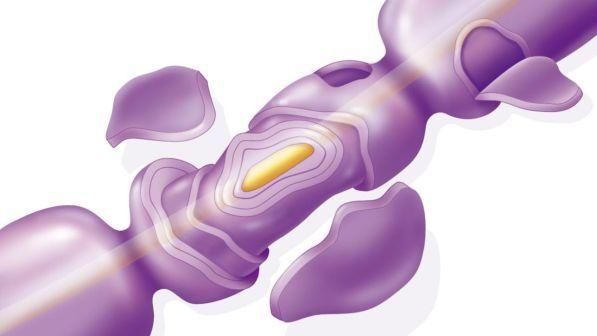Approvato un trattamento per la sclerosi multipla pediatrica