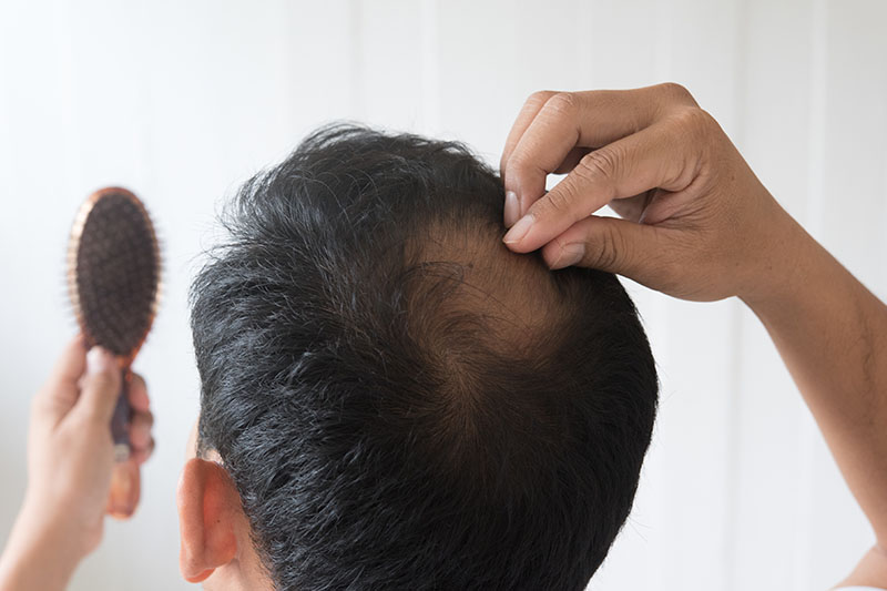 Caduta dei capelli : Ecco tutti i rimedi